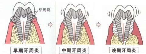 牙周病和牙周炎是一回事吗