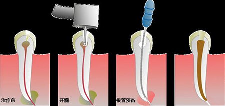 根管治疗后为什么还会有冷热刺激痛